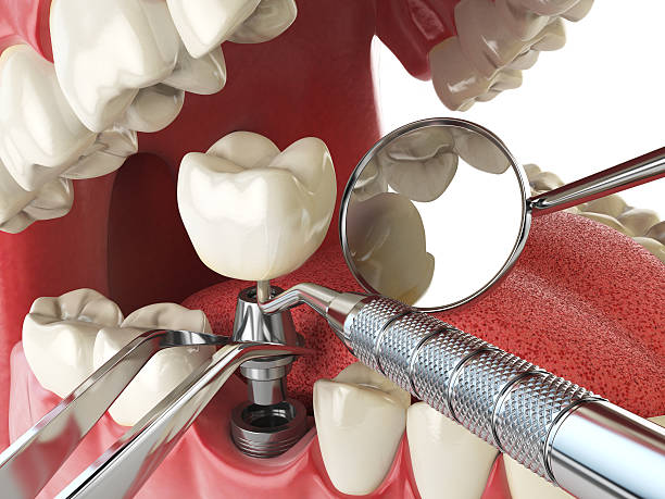 Best Emergency Dental Care for Broken or Chipped Teeth in Coldstream, KY
